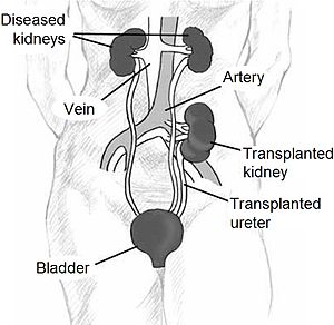 Darstellung einer heterotopen Nierentransplantation